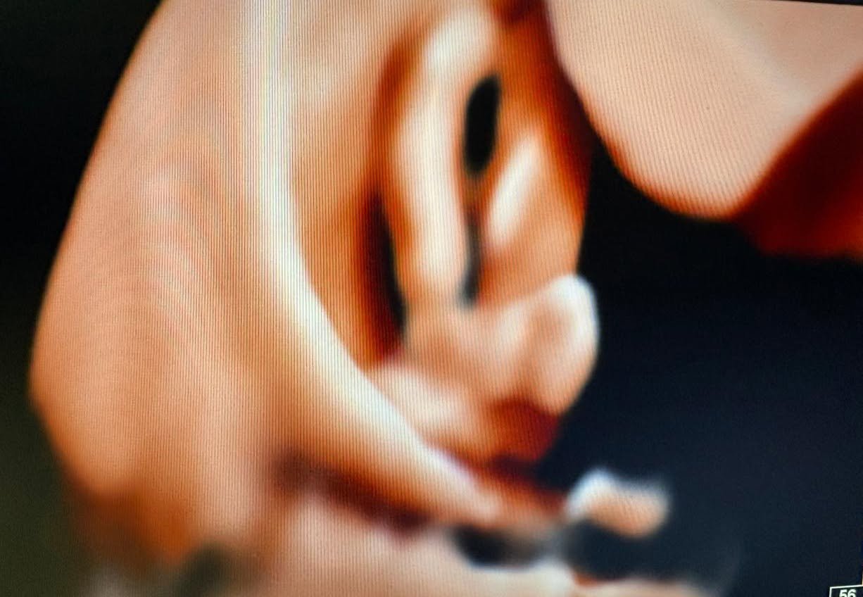 Antenatal ultrasound showing congenital club foot