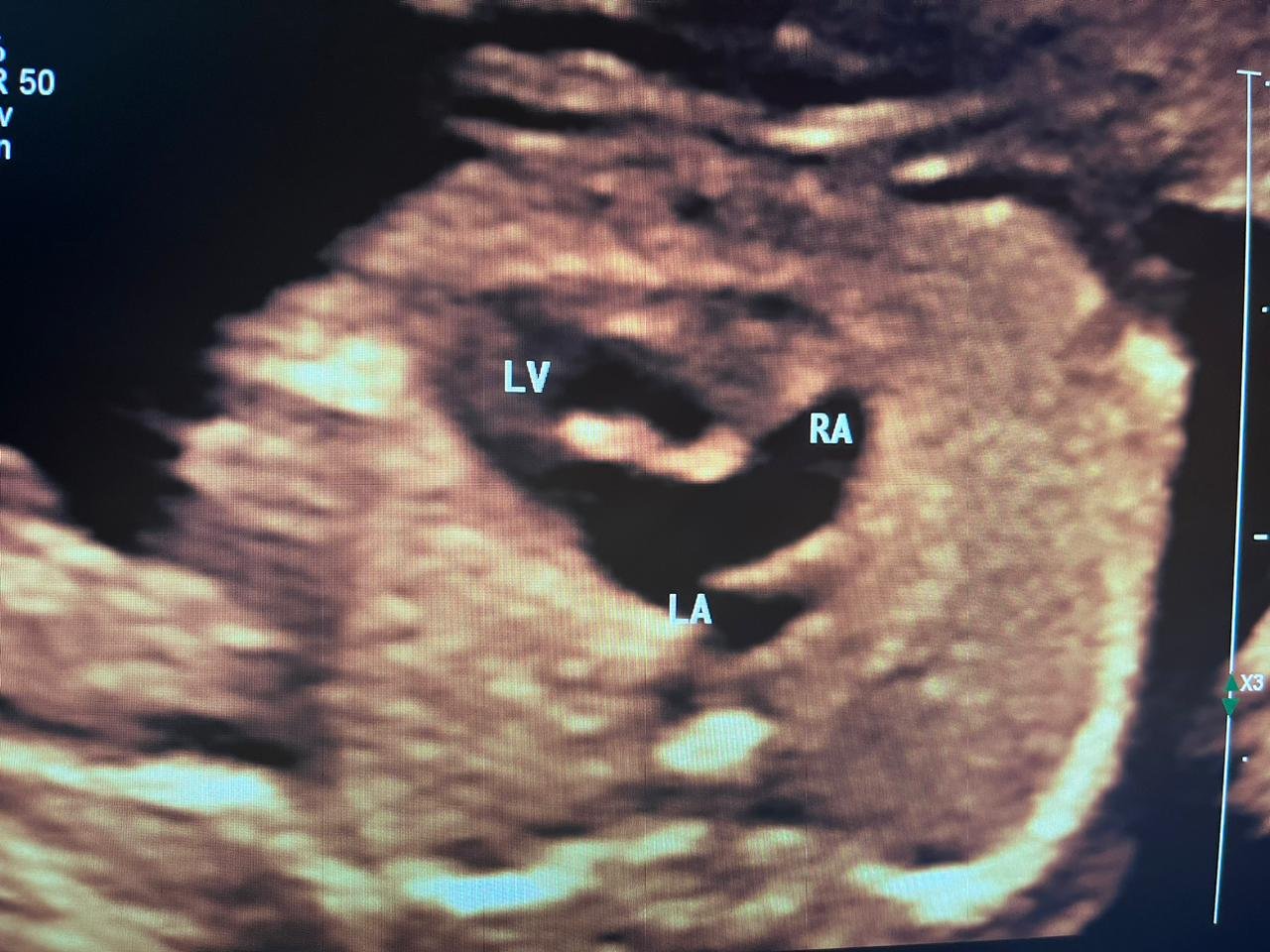 Fetal echocardiography showing DILV with unbalanced AVSD — labelled LV, RA, LA