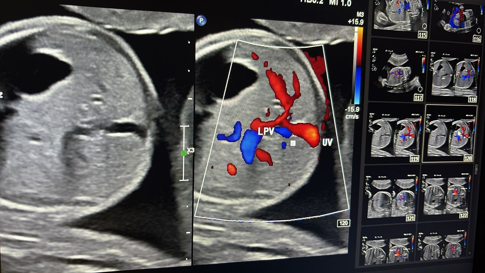 Right portal vein on colour Doppler