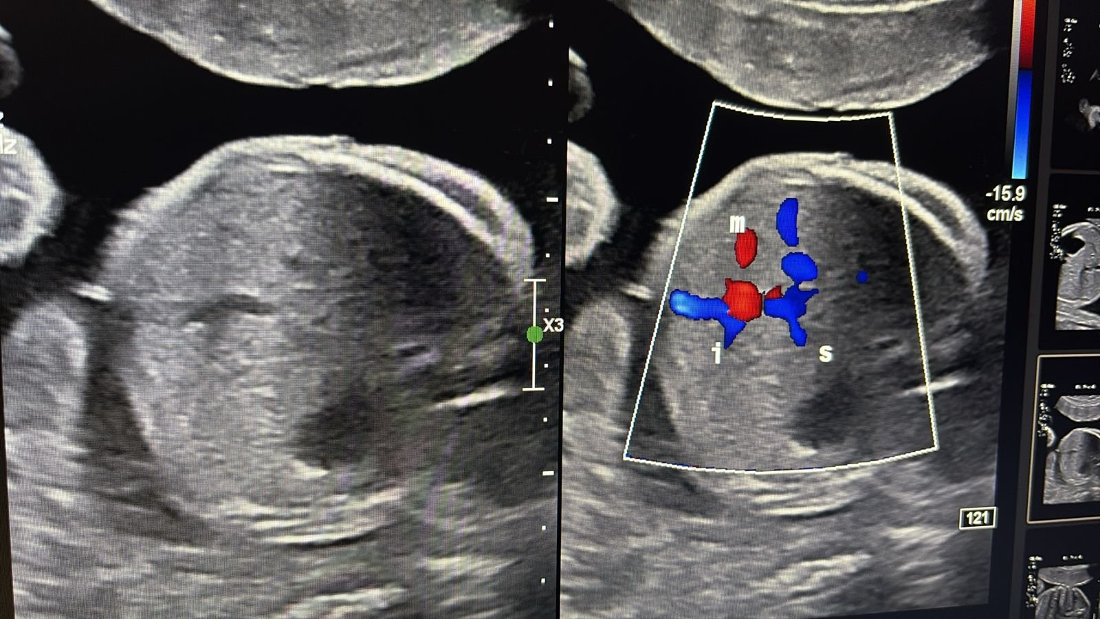 Portal venous branches on colour Doppler
